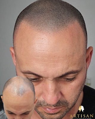 Before and after scalp micropigmentation hairline result, Artisan Scalp Micropigmentation client