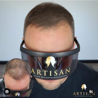 Before and after scalp micropigmentation hair density treatment for thinning hair